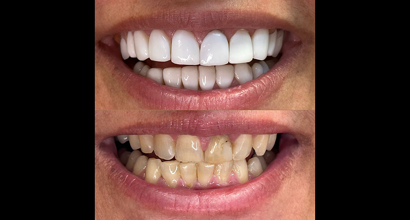 Sorriso perfeito em poucas horas já é possível aqui no centro de Gravataí - oreporter.net