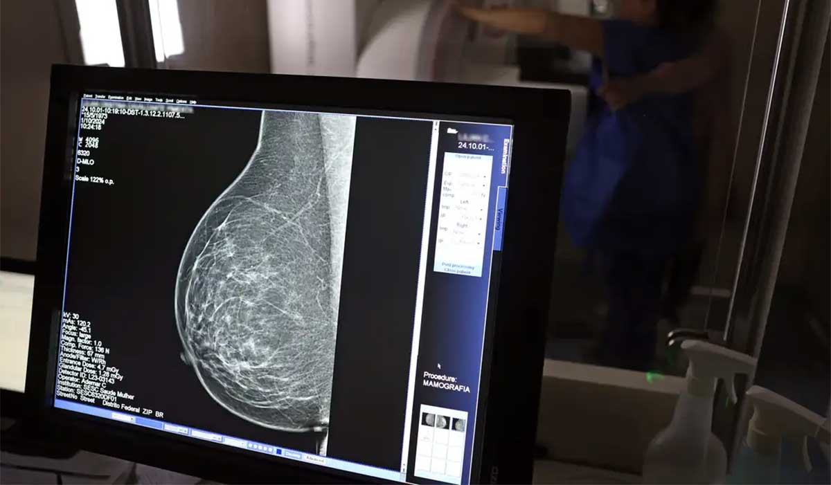 mamografia